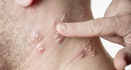 shingles infection