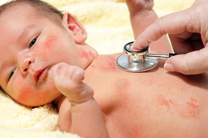 shingles-affect-babies