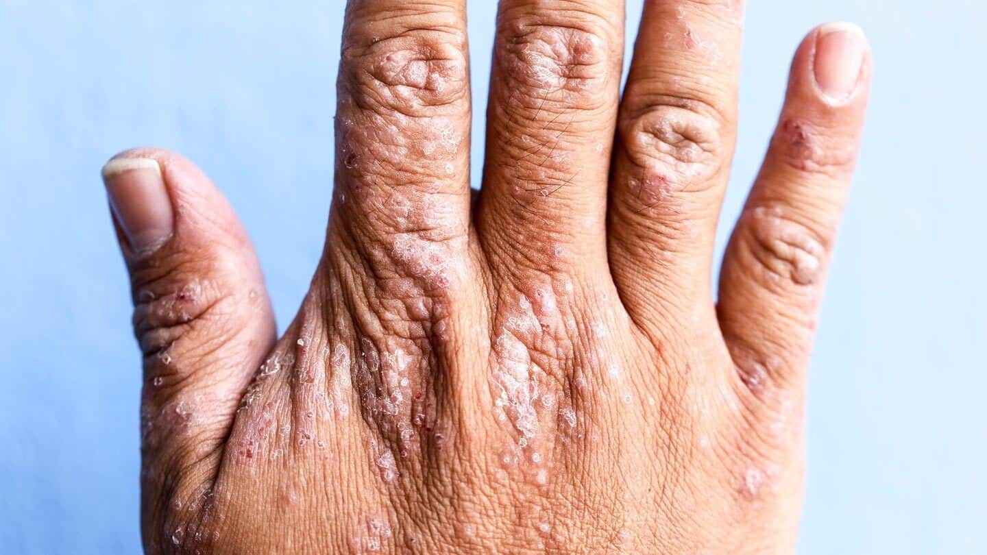 what do shingles feel like